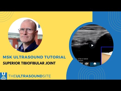 Musculoskeletal ultrasound visualisation of the superior tibiofibular joint at the knee, Rob Mast.